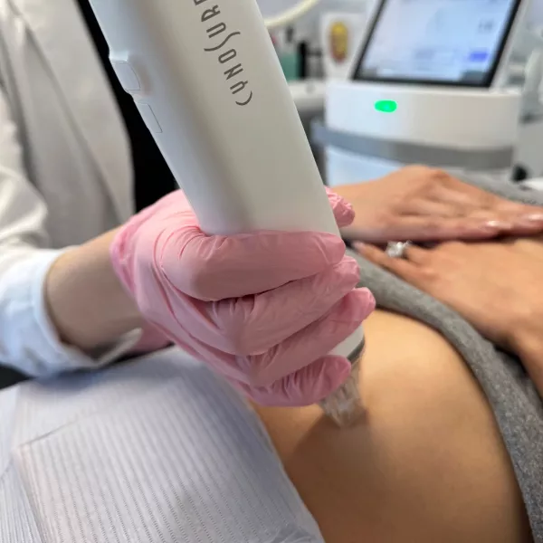 RF microneedling treatment at Vanity Compound