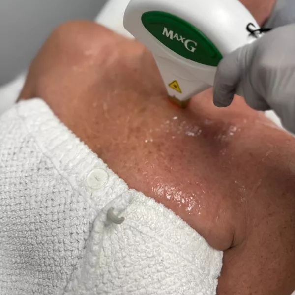 Stretch mark laser treatment at Vanity Compound