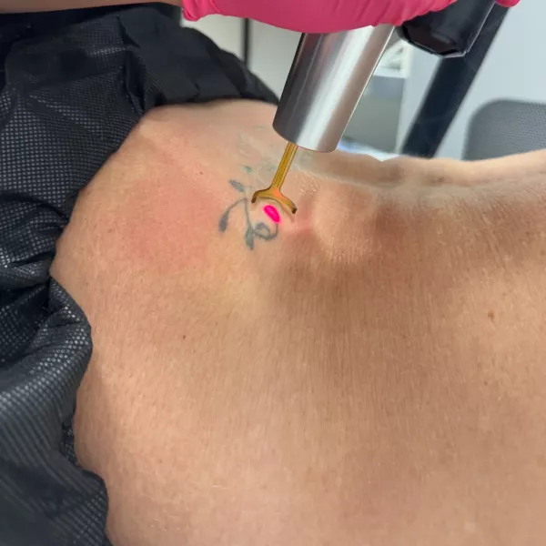 PicoWay laser tattoo removal at Vanity Compound