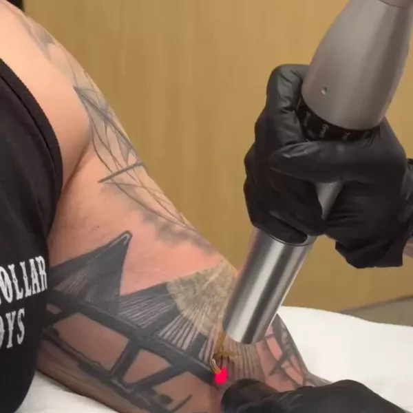 Laser tattoo removal session in progress