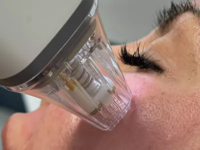 Potenza RF microneedling handpiece in use